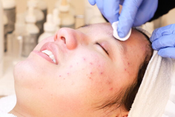 Acne behandeling van een gelaat