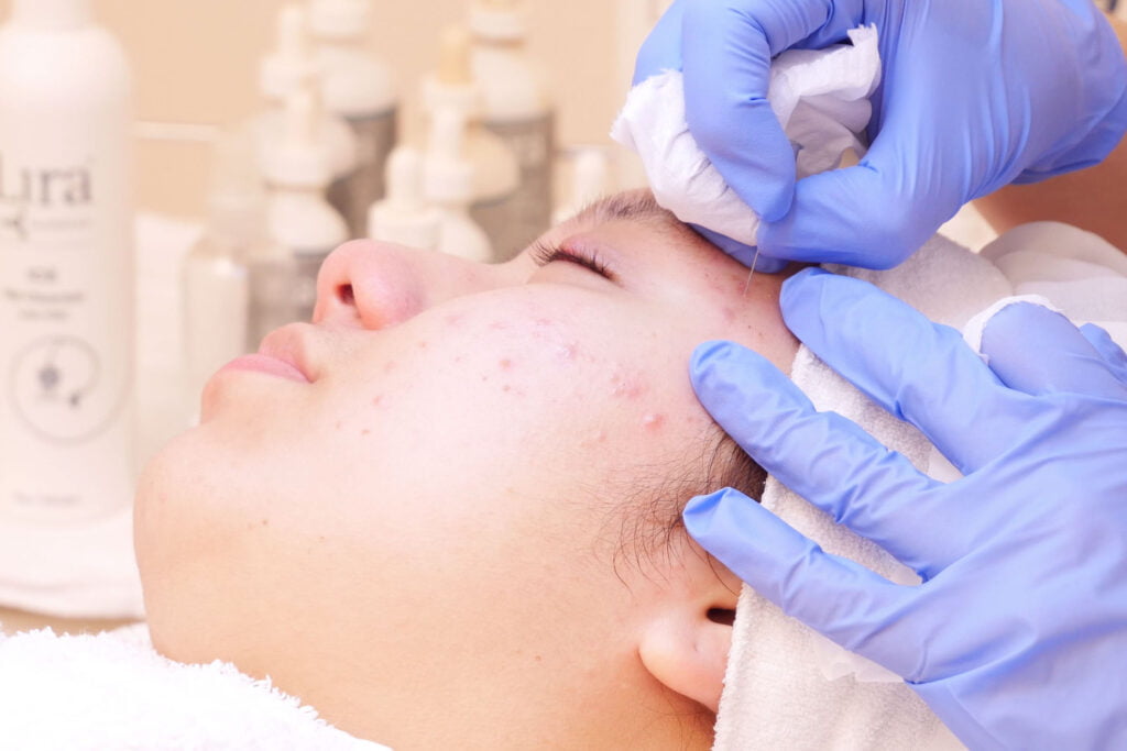 acne behandeling gezicht aanprikken van ontstekingen