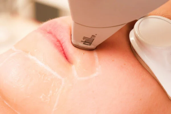 Definitief ontharen gelaat