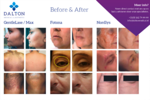 resultaten laser-behandelingen