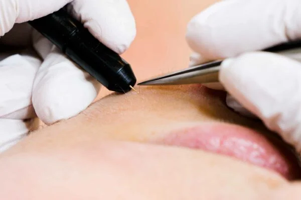 Elektrische epilatie