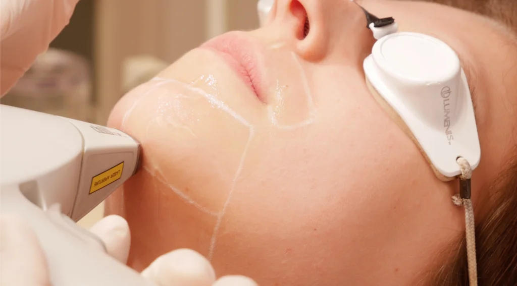Het Verschil Tussen Laser En Ipl Ontharen - Laser Ontharing Technologieën -SoCleanClinic.be thumbnail