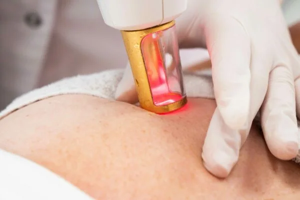 Striae behandeling Striae behandeling