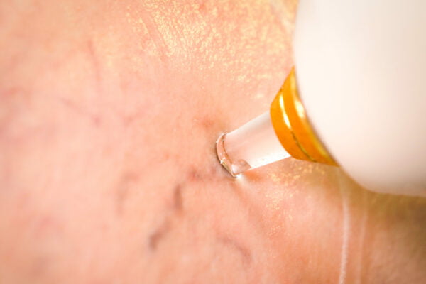 Huidbehandeling verwijderen vaatjes met laser
