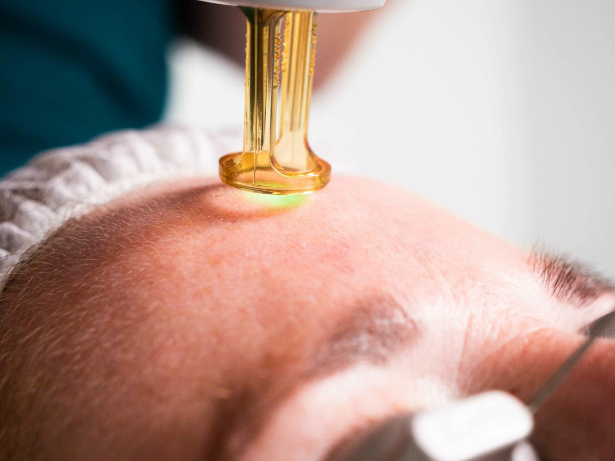 huidverjonging met laser