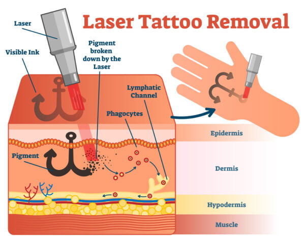 Tatoeage verwijderen met laser
