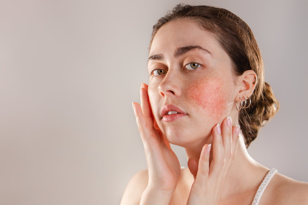 Rosacea verspreid over wangen