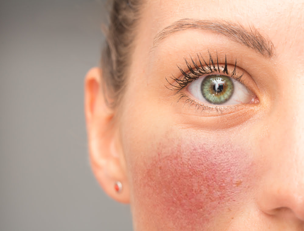 Rosacea met minimale couperose op de wang
