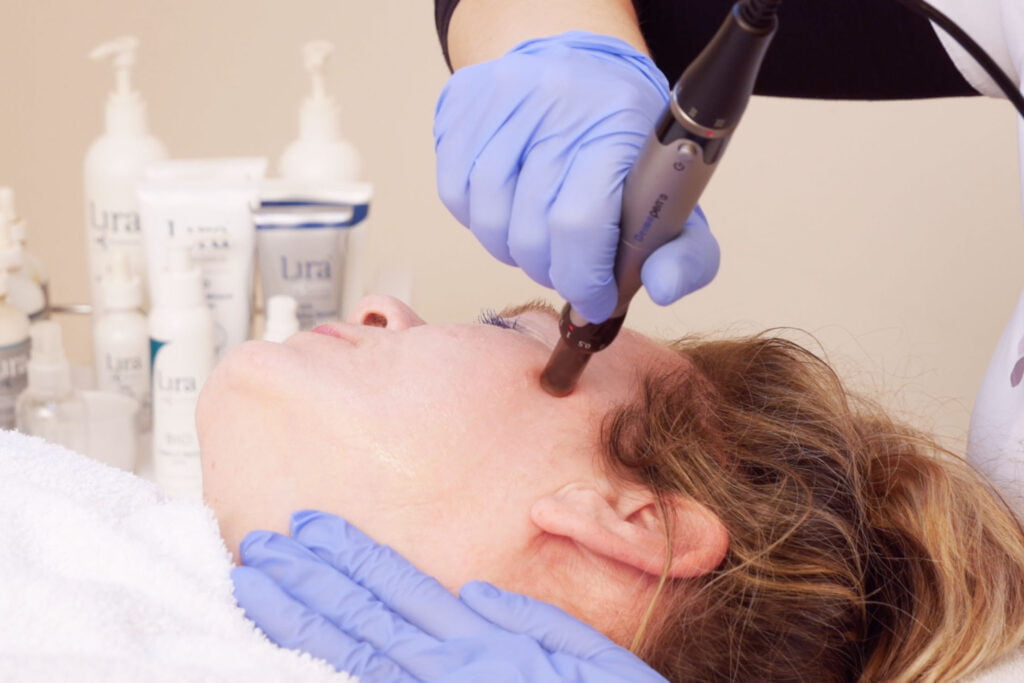 microneedling op wang voor huidverbetering