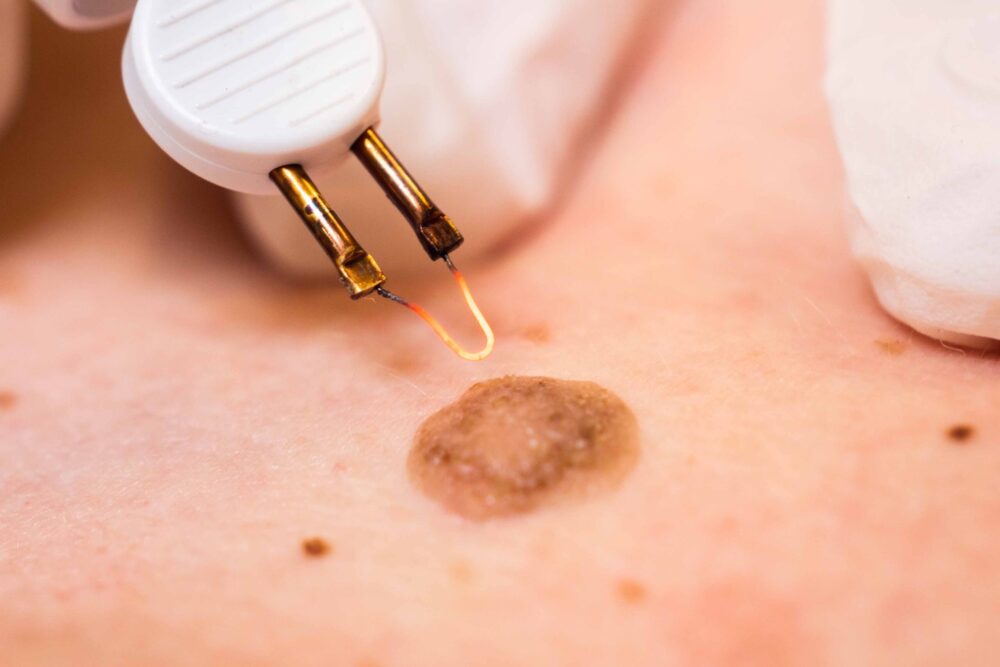 coagulatie behandeling